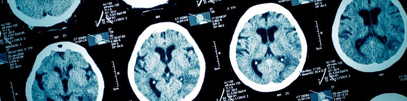 Head Injuries May Lead To Serious Brain Diseases