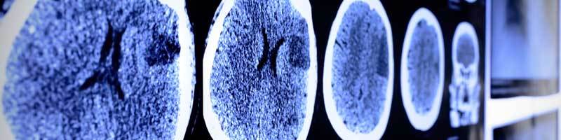 Common Brain Injuries in Accident Cases