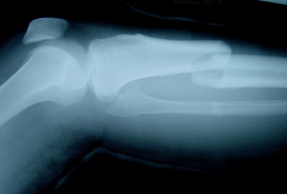 What Should I Do If My Child Is Injured in a Central California Valley Car Accident?